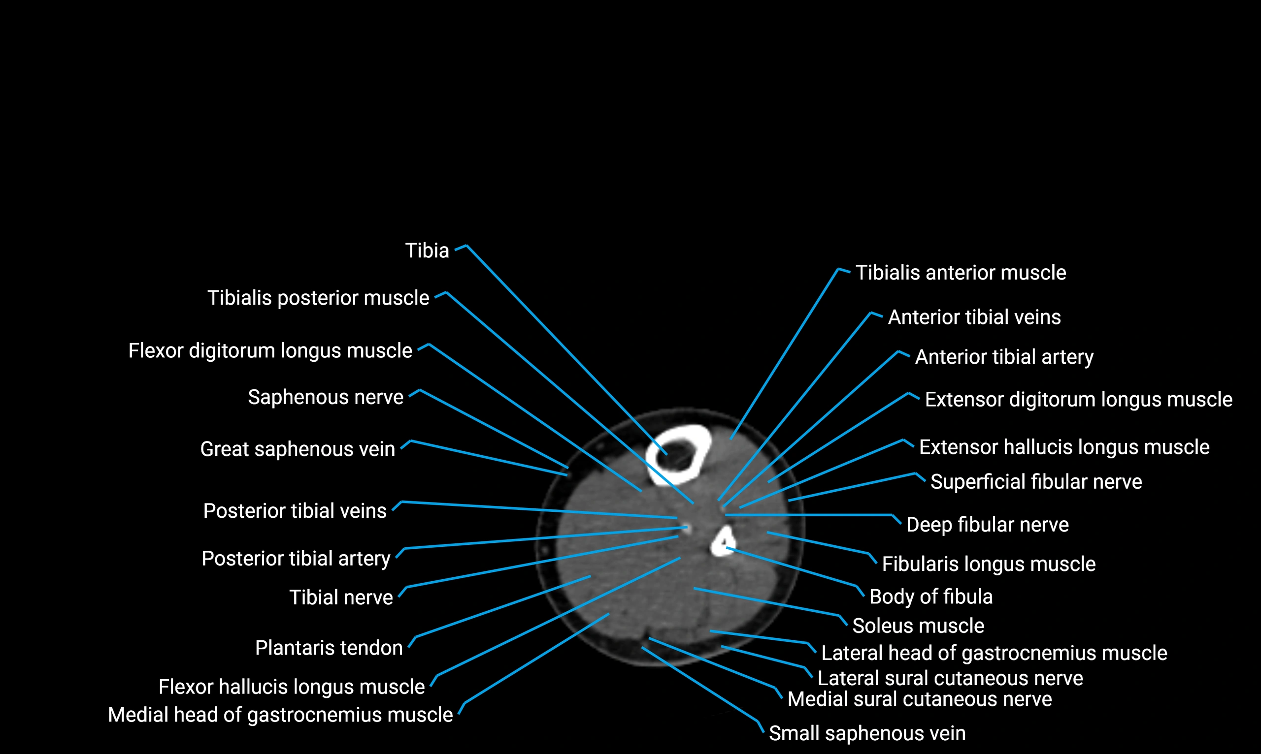 CT lower limb axial cross sectional anatomy labelled image 114 (2).webp